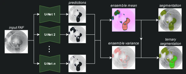 Method diagram: an ensemble of U-Nets segments hyperfluorescence in retinal autofluorescence images, combined into a ternary segmentation